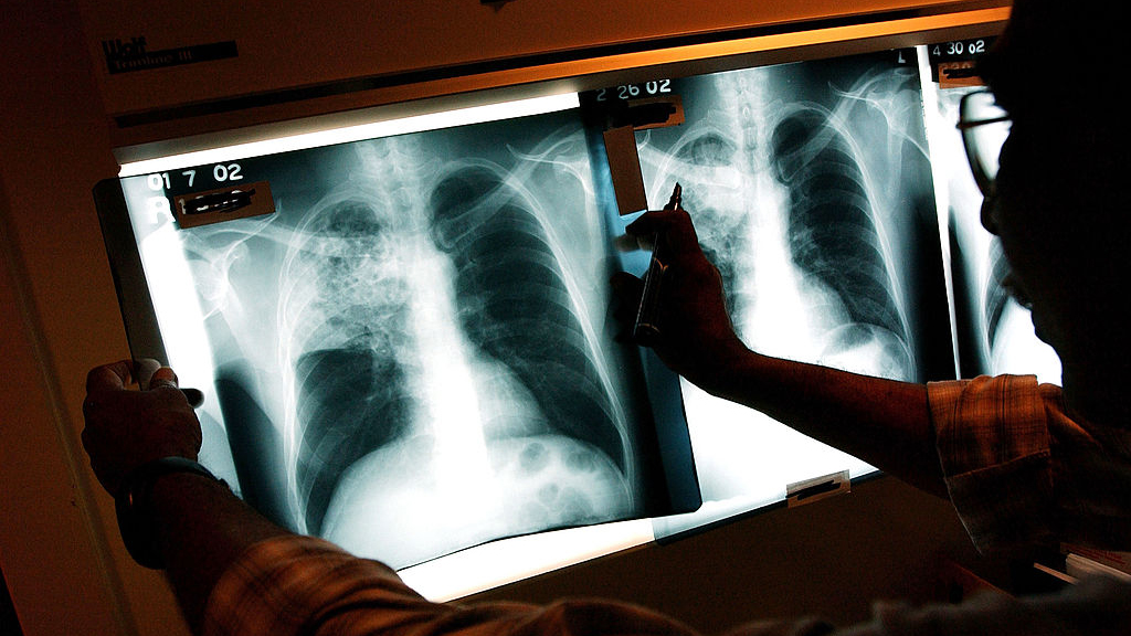 2 active tuberculosis cases traced to San Francisco strip club — KTVU FOX 2 Bay Area, Half Moon Bay Health news